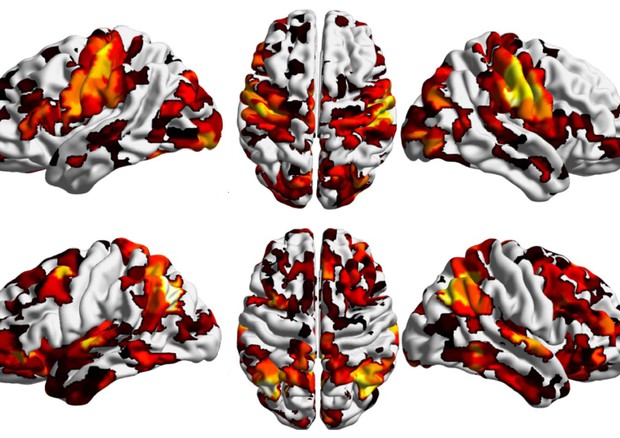 Cervello, trovata la ‘culla’ della schizofrenia