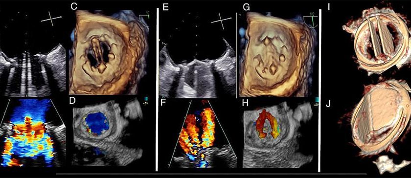 La tecnologia Novostia per le protesi valvolari cardiache raccoglie 6,5 milioni di franchi svizzeri per iniziare i suoi primi trial clinici