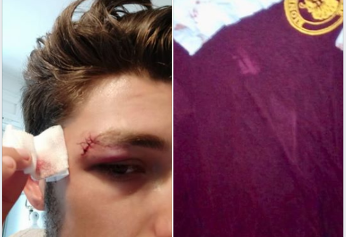 “Hai una maglia antifascista”, gli rompono il naso