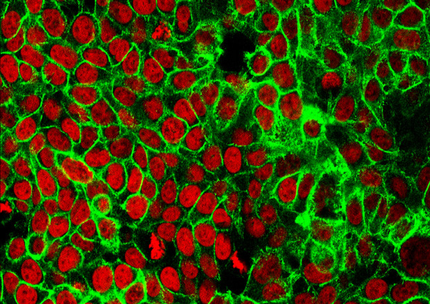 Tumori, in sangue e urine nuove spie per la diagnosi precoce