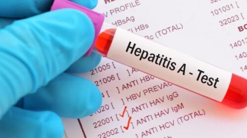 Epatite A, 12 contagiati a Salerno e provincia: avrebbero mangiato frutti di mare Epatite A, 12 contagiati a Salerno e provincia: avrebbero mangiato frutti di mare